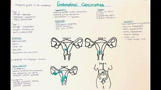 Endometrial Carcinomas - Types, Diagnosis, Therapy, Symptoms