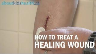 How to care for a healing wound | AboutKidsHealth at The Hospital for Sick Children