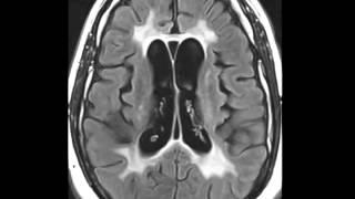 HIV Leukoencephalopathy