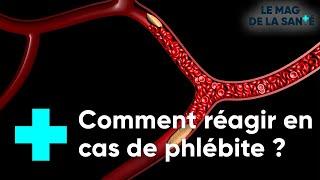 Phlébite : gare à l'embolie !  - Le Magazine de la Santé