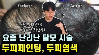 SMP 두피문신 vs 두피페인팅 (효과, 부작용, 실제 후기, 장단점 비교)