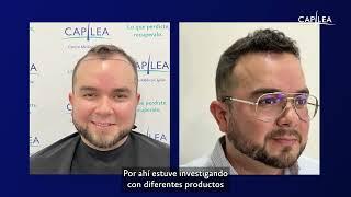 TESTIMONIO INJERTO CAPILAR/ PACIENTE CAPILEA.