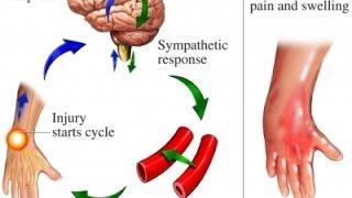 Complex Regional Pain Syndrome (CRPS)