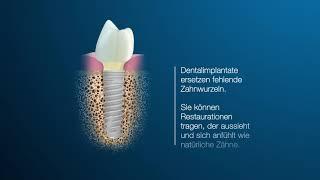 Was sind Zahnimplantate?