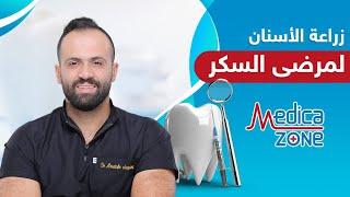 هل يمكن زراعة الاسنان لمرضى السكر ؟ | دكتور مصطفى العجمي