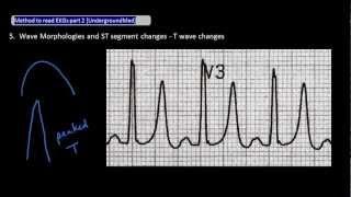 Method to Read EKG part 2 [UndergroundMed]