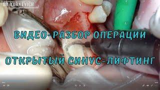 Открытый синус-лифтинг: разбор операции! Как закрыть перфорацию? Как удалить корень через пазуху?