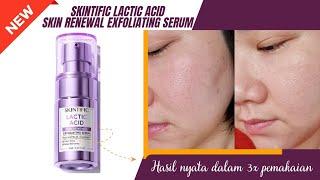 REVIEW SKINTIFIC LACTIC ACID SKIN RENEWAL EXFOLIATING SERUM || AMAN UNTUK PEMULA