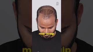 Two Months Hair Transplant Progress | Latest Fue Technique #shorts #viral #hair transplant
