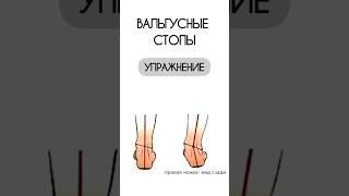 Вальгусные стопы #вальгусудетей #впльгусныестопы #вальгус