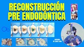 Reconstrucción Pre Endodóntica  con Dr Lauro León