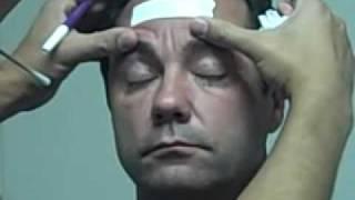 Dr. Epstein - Upper and Lower Blepharoplasty Markup - Male Patient