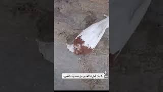 علاج التواء الرقبة