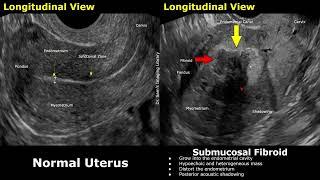 Uterus Ultrasound Normal Vs Submucosal Fibroid Cases | FIGO Classification Of Leiomyomas USG