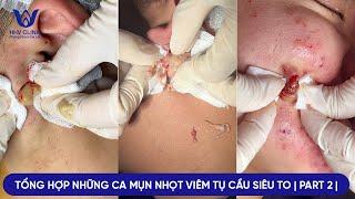 ĐIỀU TRỊ NHỮNG CA MỤN VIÊM TỤ CẦU - ÁP XE SIÊU TO KHỔNG LỔ TẠI PHÒNG KHÁM DA LIỄU HHV CLINIC -PART 2