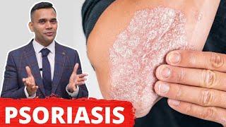 Psoriasis Treatment - The Best 2 Remedies For Psoriasis