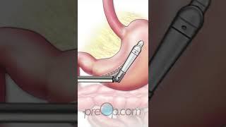 PreOp® Laparoscopic Gastric Sleeve Surgery  #preop #patienteducation #medicine #medical #weightloss