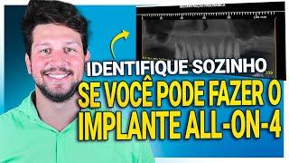 Aprenda a Identificar SOZINHO se Você Pode fazer o IMPLANTE DENTÁRIO ALL-ON-4