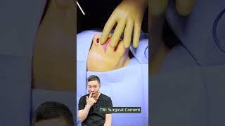 Removing Silicone Lip Filler with Dr. Young Cho at Integrated Aesthetics