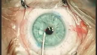 Augenlaser OP LASIK - Dr.med. Amir-Mobarez Parasta | MUNICH EYE