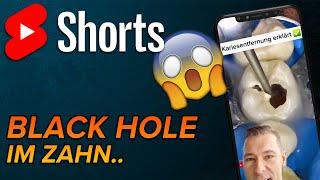 Extreme Karies Profunda #shorts