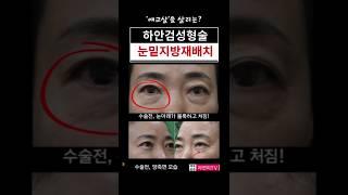 애교살보존 하안검성형술  가능할까?#눈밑지방재배치 #하안검성형재수술 #신촌성형외과 #근막초고정 #눈밑심술보 #애교살 #연세자연미성형 #홍대성형외과 #외안각고정 #은평성형외과