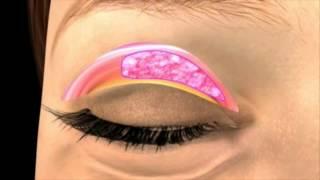 عملية تجميل الجفون Eyelid Surgery