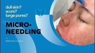 How to Treat Large Pores, Uneven Skin Texture, Pigmentation and Wrinkles - Microneedling Treatment