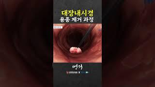 What if you found a polyp during colonoscopy?