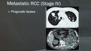 Renal Cell Carcinoma