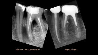 Коронка на зуб с кистой. Лечение кисты зуба. Киста зуба. Периодонтит Винир керамический Циркон Штифт