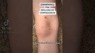 ️Warning️ TREATING MOLLUSCUM CANTHARIDIN SCARRING Avoid my #parentfail  #dermatologist