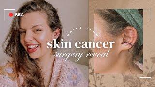 Skin cancer surgery reveal & skincare routine  morning in the life