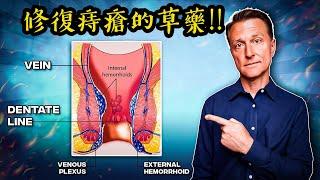 痔瘡,靜脈曲張、護肝的最佳草藥,自然療法,柏格醫生 Dr Berg