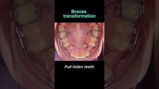 Braces transformation. Hiden teeth, not problem  #braces #orthodontist #dentist #dental