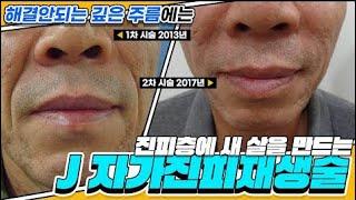 깊은 팔자주름에 고민이신 분들은 이 영상 보세요