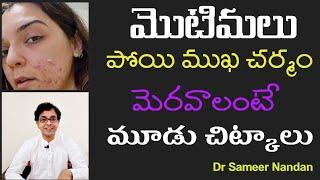 Quick & Permanent cure for PIMPLES - for all ages- Dr Sameer Nandan