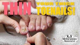 Thick Toenails Remedy