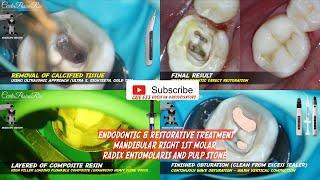 ROOT CANAL TREATMENT IN MOLAR WITH RADIX ENTOMOLARIS & PULP STONE + PRE & POST ENDODONTIC FILLING️