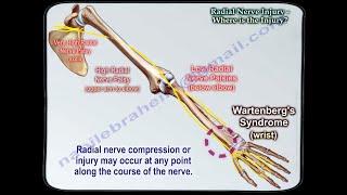 Radial Nerve Injury,Where Is The Injury - Everything You Need To Know - Dr. Nabil Ebraheim