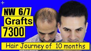Hair Transplant Result in 10 Months, 7300 Grafts, Grade 6/7, @ Eugenix by Expert Hair Surgeons