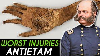 The WORST Wounds from the Battle of Antietam