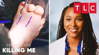 Incredible Toe Removal Surgeries | My Feet Are Killing Me | TLC