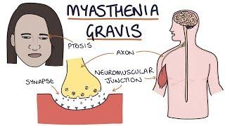 Myasthenia Gravis