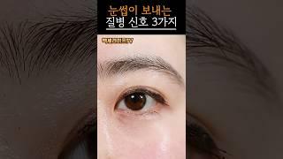 눈썹 꼬리가 사라진다면 병원 가야 합니다｜갑상선 경고