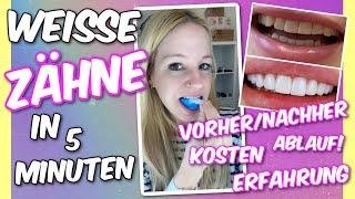 Neue Zähne von Veneera | Meine Erfahrungen mit dem Zahn-Veneer 2.0 - besser als echte Veneers?