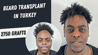 Afro Beard Transplant in Turkey | Afro Beard Transplant Process  #beardtransplant #fue