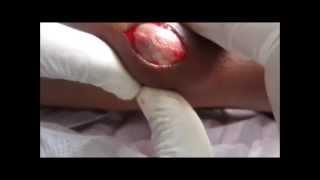 Sebaceous Cyst On Arm