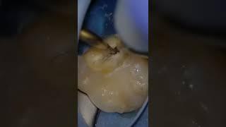 THE MAGIC OF ULTRASONICS IN ENDODONTICS ON DISPLAY! 