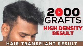 FUE Hair Transplant Results | QHT FUE Hair Transplant Results